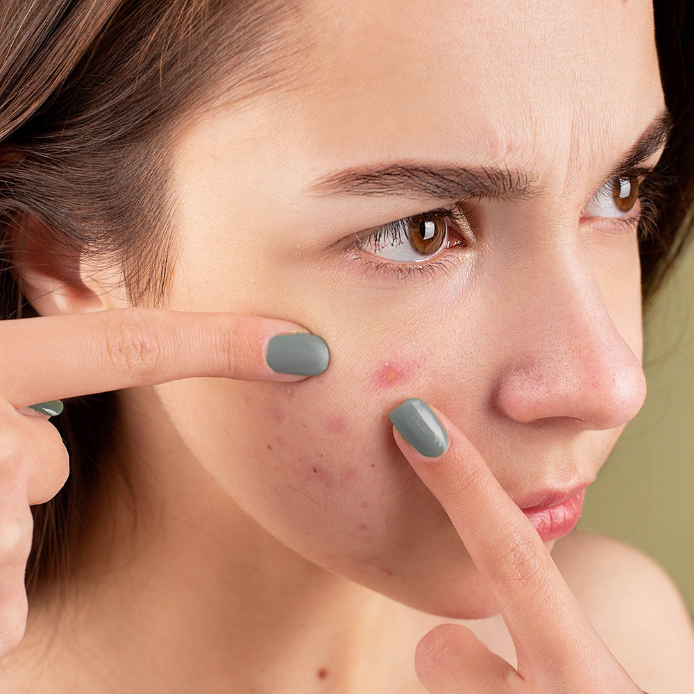 Laser Acne Therapy
