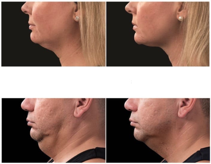Double Chin Reduction in Winnipeg