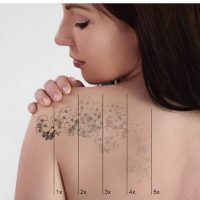 Tattoo line reduction